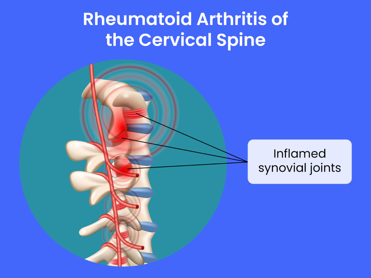 Rheumatoid Arthitis